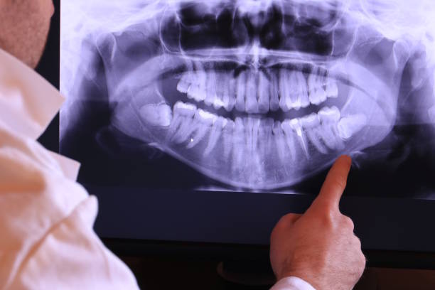 Best Emergency Dentist for Knocked-Out Tooth in Califon, NJ